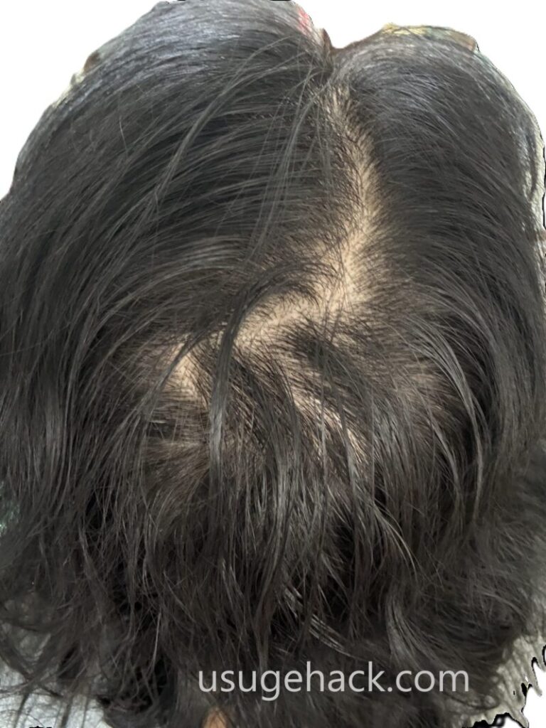 朝の寝起きの後頭部の薄毛・つむじのパックリ割れ。増毛スプレー使用前の状態を後ろから撮った写真