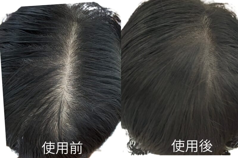 アートミクロンプラビ（ヘアファンデーション）の使用前と使用後の分け目の比較。薄毛カバーの効果