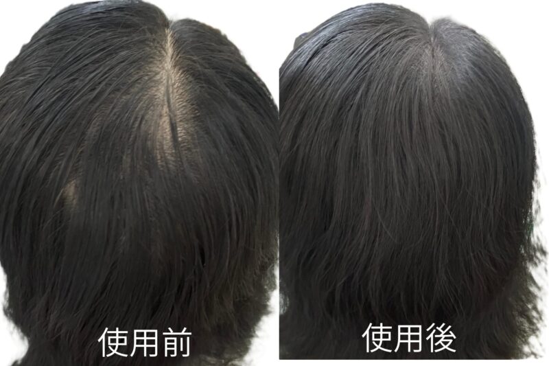 アートミクロンプラビ（ヘアファンデーション）の使用前と使用後の後頭部の比較。薄毛カバーの効果