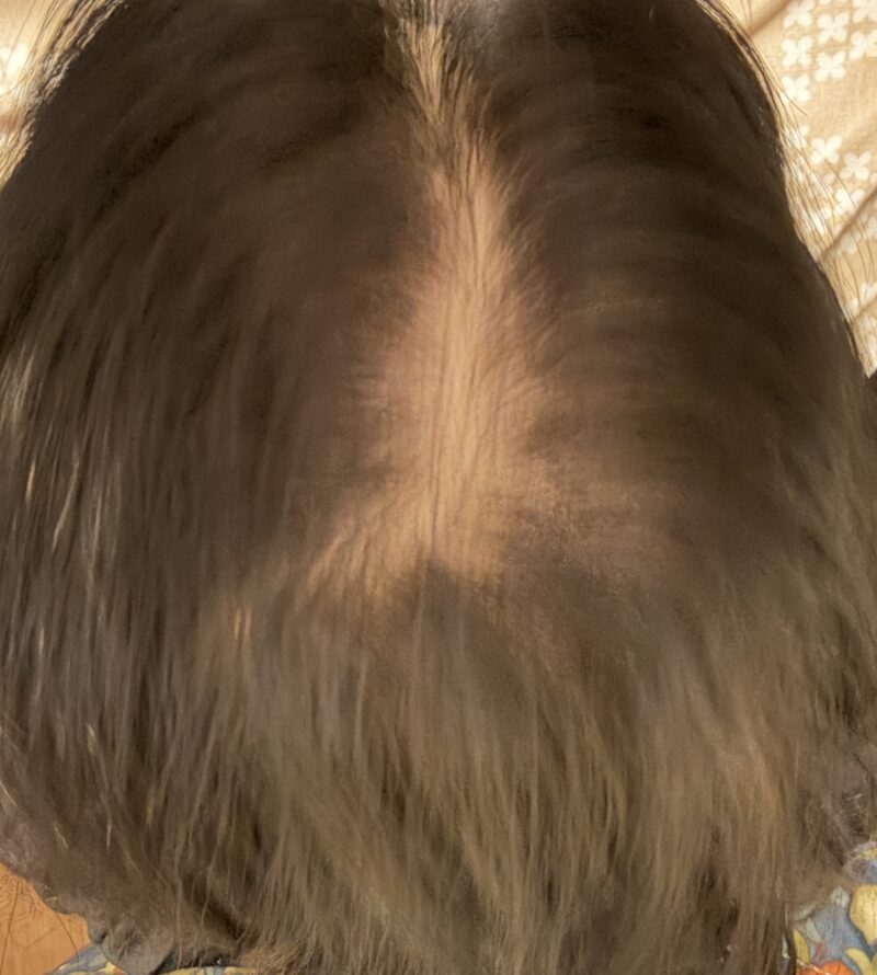 頭頂部（つむじ周辺）を真上から撮影した写真。分け目の地肌の見え方と髪のボリューム感の状態。