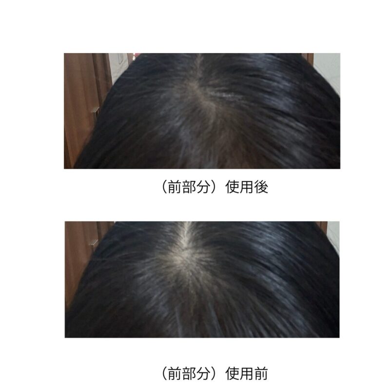 ビオルチア（Bio Lucia）ヘアパウダーの前髪・生え際への使用比較。上が使用前、下が使用後の写真。地肌の透けと白髪のカバー効果。