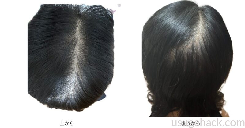 筆者の頭皮を上から撮った写真(左)後ろから撮った写真(右)
