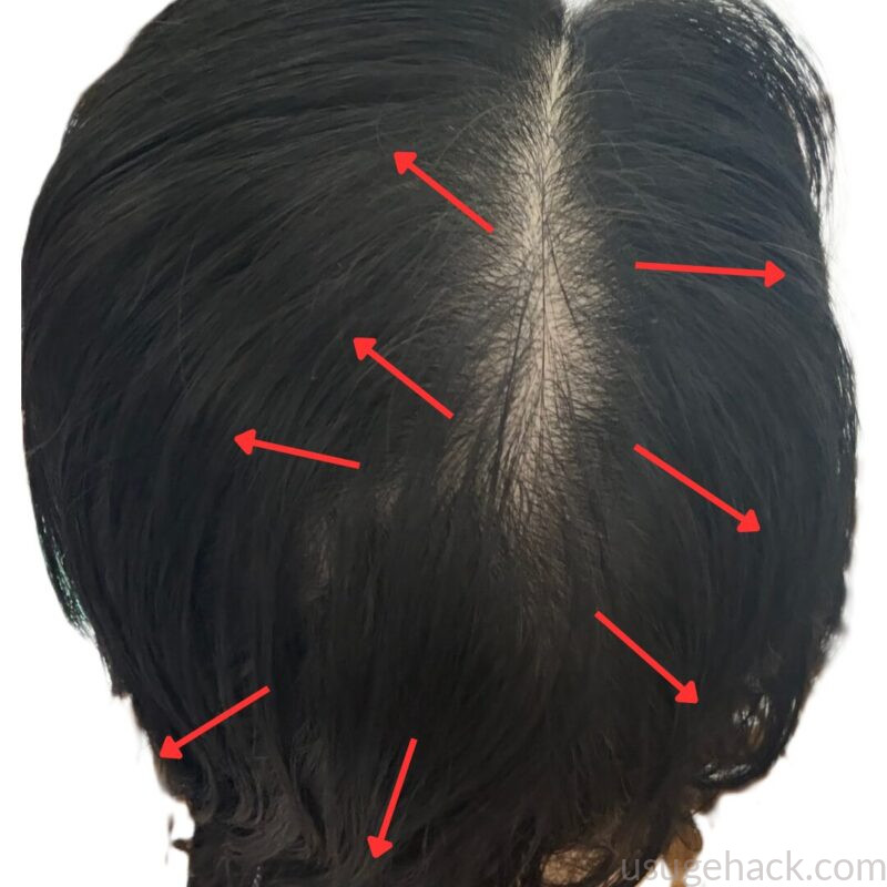 後頭部の強い生え癖を赤い矢印で示した写真。ヘアリセッターを試みようと思ったきっかけとなった生え際の状態
