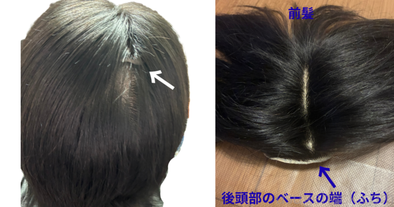 気になる白髪と「スケスケのスキン」問題